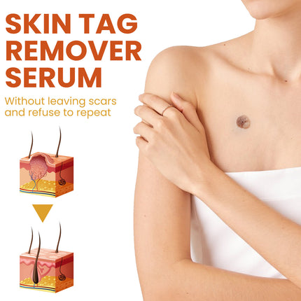 OUHOE Skin Wart Remover