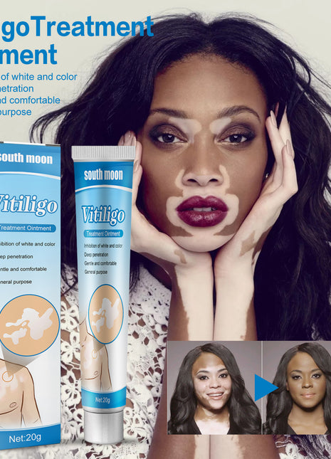 South Moon Vitiligo Treatment Ointment | Targeted Skin Pigmentation Care Cream