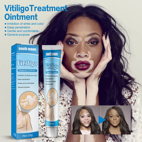South Moon Vitiligo Treatment Ointment | Targeted Skin Pigmentation Care Cream