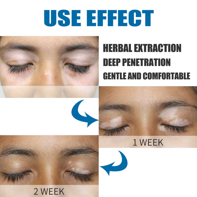 South Moon Skin Spot Removal Cream