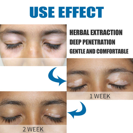 كريم إزالة بقع الجلد ساوث مون