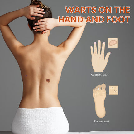 OUHOE Skin Wart Remover