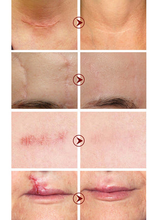 LANBENA Crema Herbal para Eliminar Cicatrices | Crema Hidratante para el Cuidado de Cicatrices y Estrías