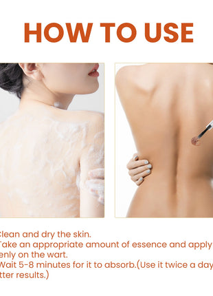 OUHOE Skin Wart Remover Solution | Targeted Spot Care Formula