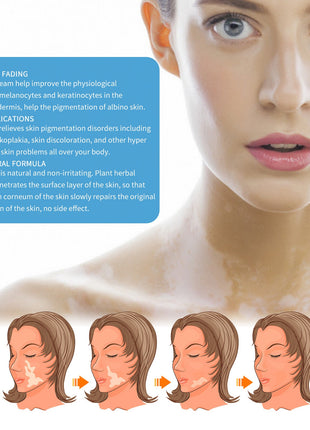 South Moon Crema de Tratamiento para Vitiligo | Crema para el Cuidado Dirigido de la Pigmentación de la Piel