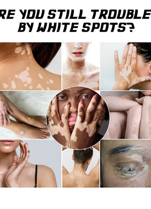 South Moon Crema de Tratamiento para Vitiligo | Crema para el Cuidado Dirigido de la Pigmentación de la Piel